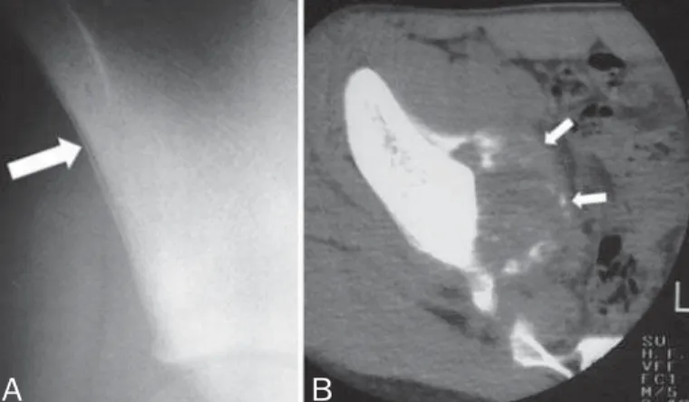 Figure 10.  Case 10. Chondrosarcoma. Thirteen-year-old girl. A: Peri- Peri-osteal, single lamellar reaction (arrow)