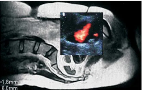 Figure 2. Color Doppler ultrasound of bladder in the longitudinal plane, demonstrating ureterovesical jet.