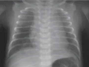 Figure 2. Oblique chest x-ray of a newborn infant demonstrating bilateral clavicles and costal arcs asymmetry.