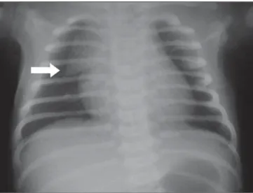 Figure 13. Newborn infant x-ray demonstrating low- low-localization of arterial umbilical catheter at the L4 level (arrow).