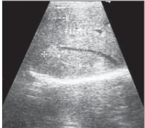 Figure 1. Hepatic hemangioma. Hyperechogenic nodular image.