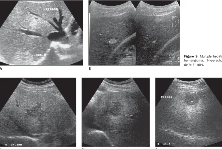 Figure 9. Multiple hepatic hemangioma.  Hyperecho-genic images. A B CBA