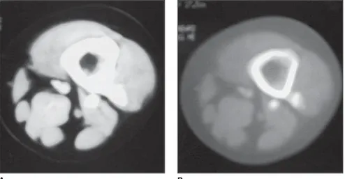 Figure 1. CT image of coxa, bone window (A) and soft tissues (B). Exostoses on the left femur posterior surface.