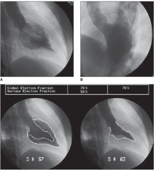 Figure 1 – Acquisition with ECG-gat- ECG-gat-ing, in cine Fiesta sequence (SSFP), T1FGRET and T1FGRIR, outflow tract plane diastole (A) and systole (B);  short-axis (C); delayed enhancement – outflow tract (D) and two LV chambers (E)