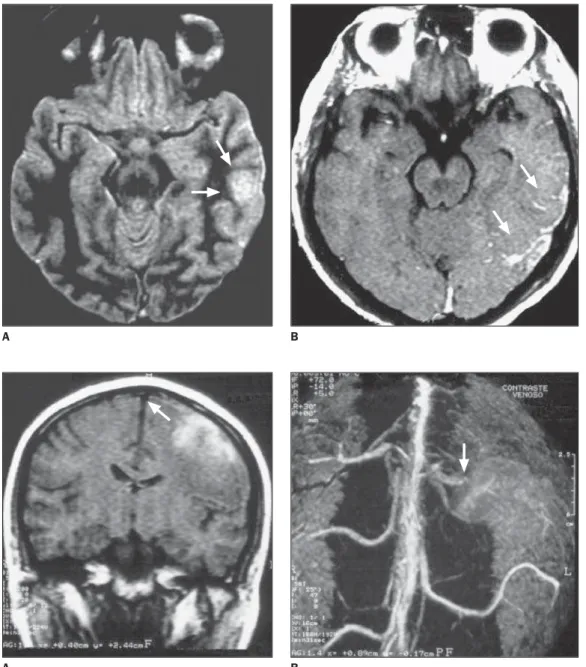 Figure 7. T2-weighted MRI (A), axial view showing a small area of cortical hypersignal on the left temporal lobe, compatible with edema or infarct (arrows)