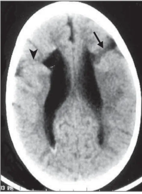 Figure 5. Bilateral schizencephaly. Small parietal open-lip cleft at left (arrow), parietal closed-lip cleft at right (arrowhead)