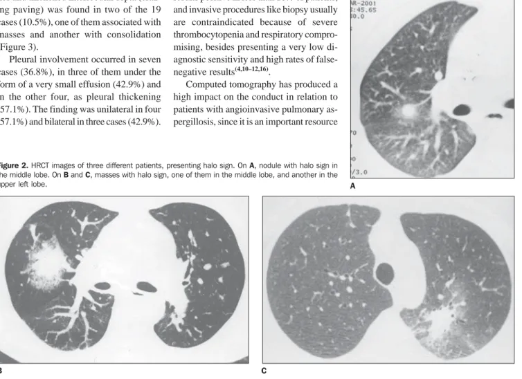 Figure 2. HRCT images of three different patients, presenting halo sign. On A, nodule with halo sign in the middle lobe