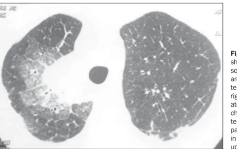 Figure 3. HRCT image showing parenchymal  con-solidation surrounded by area with ground-glass  at-tenuation localized in the right upper lobe;  associ-ated with thickened septa, characterizing mosaic  pat-tern of attenuation (crazy paving)