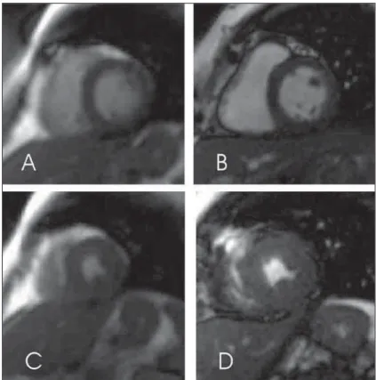 Figure 5. Short axis TrueFISP MR images of one of the patients included in the present study, demon- demon-strating endocardial contour blurring