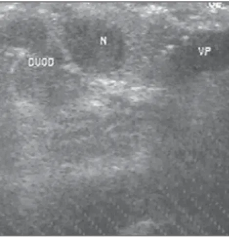 Figure 5. Hypoechogenic nodule (insulinoma) with 0.5 cm (N, insulinoma; DUOD, duodenum).