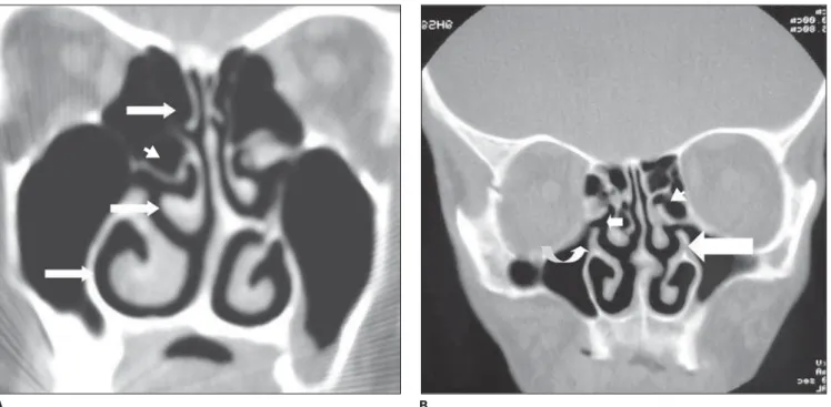 Figure 2. A: Coronal CT image shows superior, middle and inferior nasal conchas (arrows) and ethmoid bulla (arrowhead)