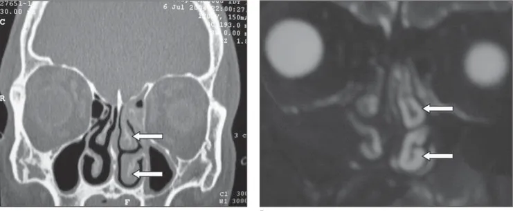 Figure 3. A: Coronal CT image shows enlarged middle and inferior nasal conchas at left (arrows)