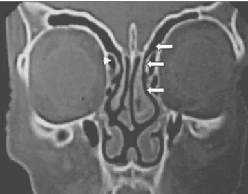 Figure 4. Coronal CT image shows the frontal recess (arrows) and agger nasi cell (arrowhead).
