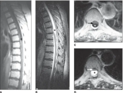 Figure 2. Axial brain MRI. A: T1-weighted showing hypointense cysts (arrows) in subarachnoid space in parietal and right frontal regions