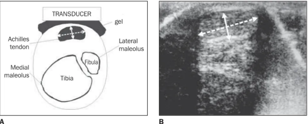 Figure 2. Diagram (A) and US transversal image (B) demonstrating checking method for Achilles tendon measurements