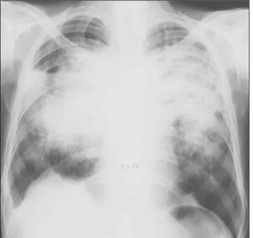 Figure 3. Mixed lesion in “butterfly-wing” pattern, with predominating confluence.