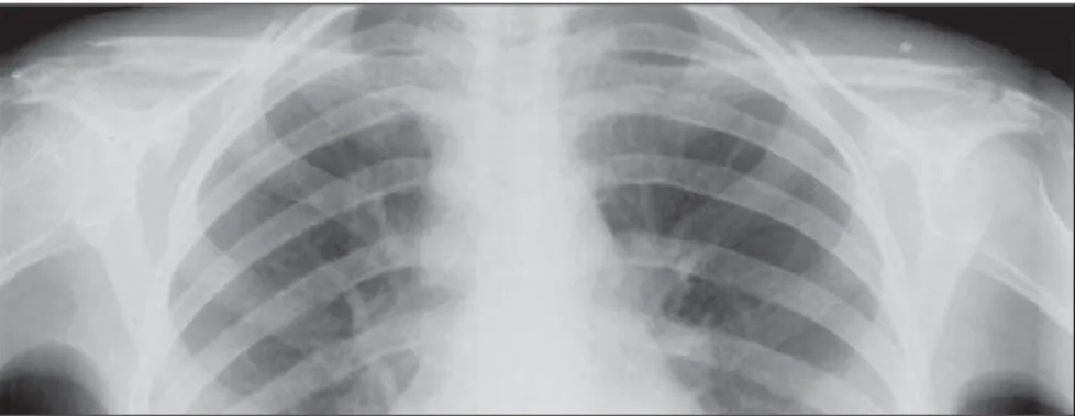 Figure 8. Osteolytic lesions of both clavicles distal extremities.