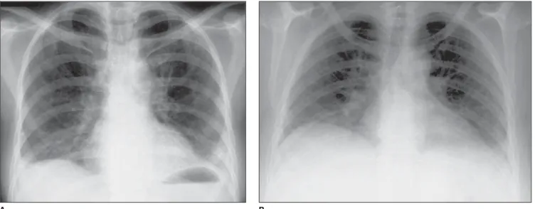 Figure 1. Examples of chest X-rays of patients with systemic sclerosis, showing pulmonary reticulation (A) that may be associated with reduction in the vertical diameter of the chest cavity (B).