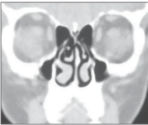 Figure 2. Coronal CT at the level of the osteomeatal complex. Right ethmoid-maxillary sinusopathy (*), probably determined by obstruction of the osteomeatal complex by bulbous-type middle concha bullosa (+).