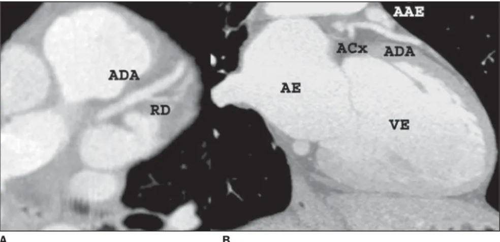 Figure 8. Oblique axial (A) and sagittal (B) reformatations showing anterior descending artery (ADA) proximal and middle portions localized in the anterior interventricular sulcus