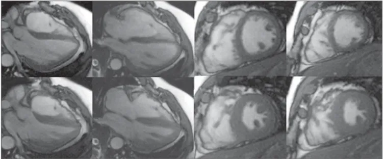 Figura 2. Aquisições acopladas ao ECG. Imagens superiores em double IR sem supressão de gordura e imagens inferiores com estudo do realce tardio em quatro câmaras varredura e eixo curto.