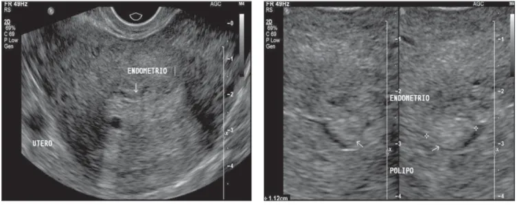 Figure 2. Sonographic study demonstrating endometrium presenting heterogeneous texture with small cysts (A), besides an image of polyp surrounded by anechoic halo (B), a pattern usually found in patients under hormone replacement therapy.