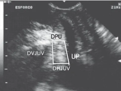 Figure 1. Transvulvar ultrasound of urethrovesical junction at stain. (UVJVD, urethrovesical junction ver- ver-tical distance; UVJHD, urethrovesical junction horizontal distance; PUD, pubourethral distance; PU, proximal urethra)