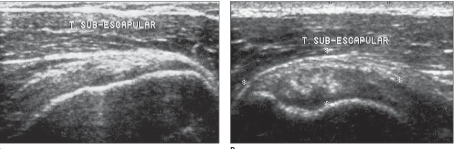 Figure 2. Longitudinal (A) and transverse (B) views. Thickened supraspinatus tendon, with heterogeneous echotexture, presenting hypoechoic focus, sugges- sugges-ting a probable partial-thickness tendon tear (arrows)
