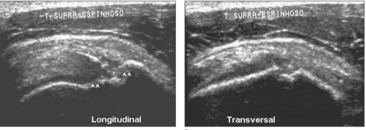 Figure 4. Longitudinal (A) and transverse (B) views. Image compatible with partial-thickness supraspinatus tendon tear associated with secondary findings.