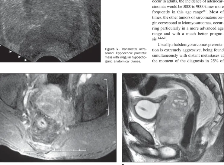 Figure 2. Transrectal ultra- ultra-sound. Hypoechoic prostatic mass with irregular  hypoecho-genic anatomical planes.