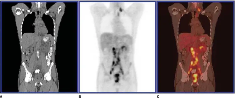 Figure 4. PET/CT image. Multiple, retroperitoneal and left supraclavicular metastatic lymph nodes.