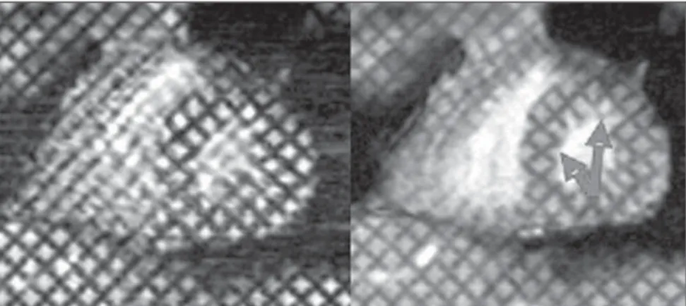 Figure 4. ECG-gated acquisition for evaluation of left ventricular contraction and relaxation during pharma- pharma-cological stress by the myocardial tagging technique