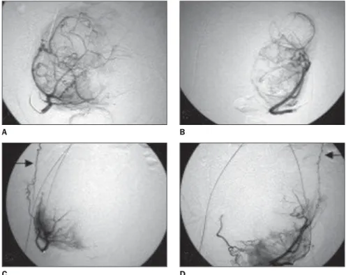 Figure 1. Standard angiographic documentation of uterine embolization procedure: A: Selective cath- cath-eterization of right uterine artery
