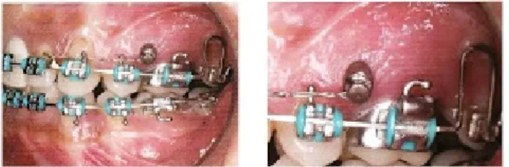 Figura 9. Fio de amarrilho conectado ao gancho e ao mini-implante com alça de Bull ativa