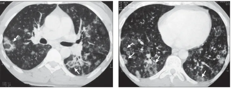 Figure 1. Case 1. HRCT showing reversed halo sign (arrows). Besides small, sparse cavitated nodules.