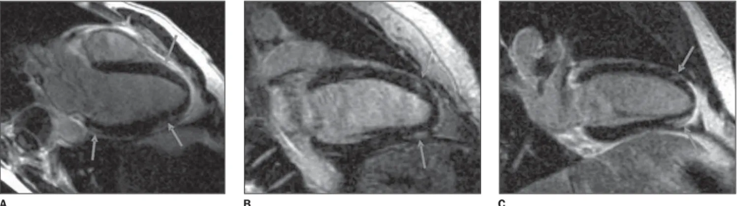 Figure 3. Images acquisition with ECG-gating. Delayed enhancement on two chamber, long axis views (A,B) and left ventricle outflow tract plane (C)