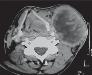 Figure 2. Axial tomographic view at the level of ventricular folds, where a volu- volu-minous tumor-like lesion is observed, causing constriction of the larynx lumen.