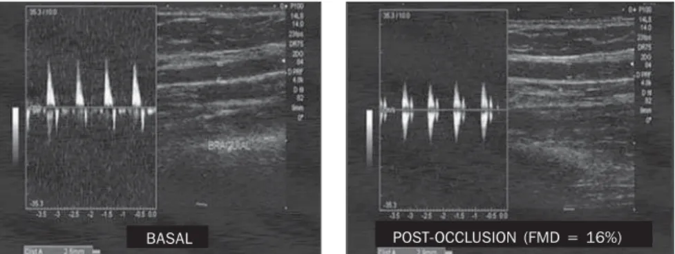 Figure 2. FMD in a patient with a good endothelial function: basal diameter = 2.5 mm; after occlusion
