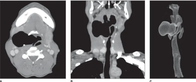 Figure 5. Axial multidetector CT images (A) and coronal reconstruction (B) demonstrate air-filled saccular formation communicating with the airway