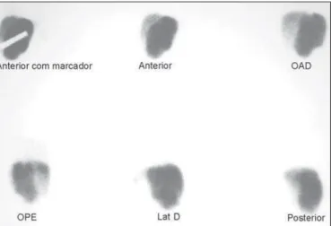 Figure 2. Hepatosplenic scintigraphy with colloidal sulfur ( 99m Tc). Planar images demonstrating an increased left lobe with increased uptake.