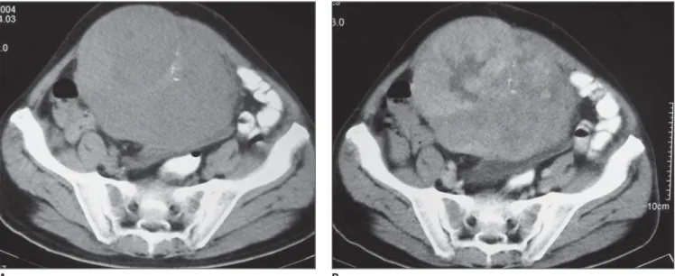 Figure 1. Mesenteric GIST. A: Well-defined mass with lobulated margins and some calcifications