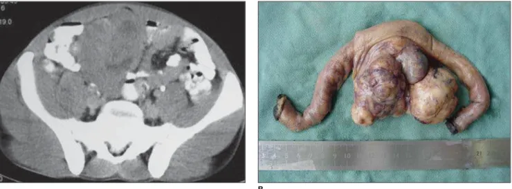 Figure 2. Small bowel GIST. A: Mass presenting soft tissues density, well-defined limits, lobulated margins, and some central, hypoattenuating areas in close contact with intestinal loops