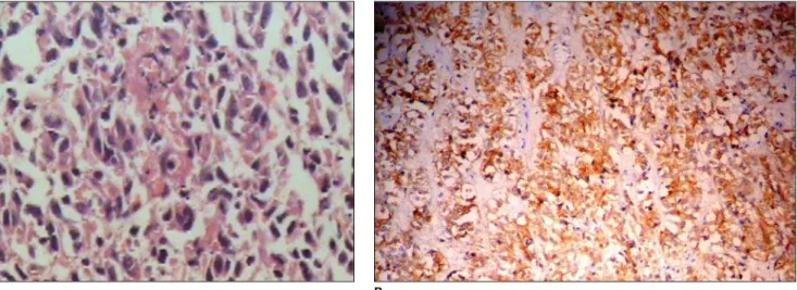 Figure 5. GIST histological and immuno-histochemical findings. A: Photomicrography shows fusiform neoplastic cell of mesenchymal origin (hematoxilin-eosin, 20× increase)