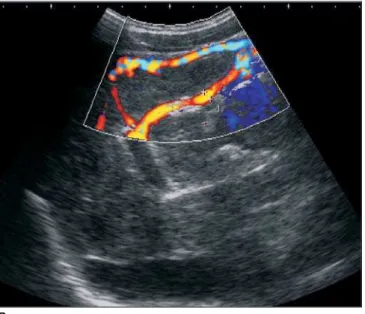 Figure 3. Cirrhotic patient with perisplenic and retroperitoneal collateral cir- cir-culation (A), and umbilical vein recanalization (B)