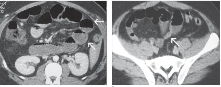 Figure 1. Intestinal obstruction by adhesion. A: Small bowel loops distension (arrows)