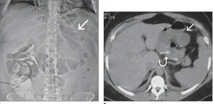 Figure 2. Transmesocolic internal hernia. A: Topogram demonstrating distension of supramesocolic, small bowel loops (arrow)