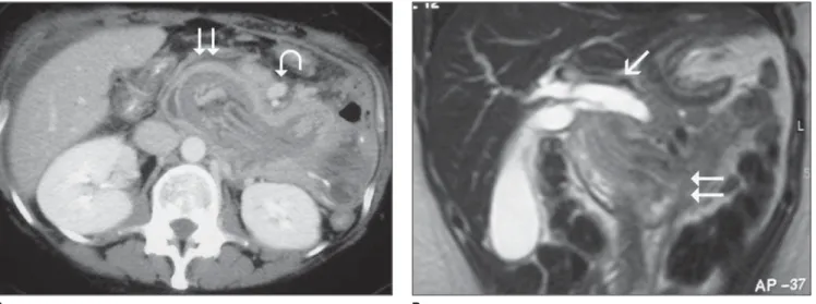 Figure 4. Gastric intussusception. A: Computed tomography at the level of the third duodenal portion