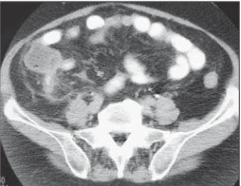 Figure 6. Computed tomography. Female, 50-year-old patient. Acute appendicitis. Cecal thickening (ar- (ar-row), blurring of periappendicular fat and appendix thickening.