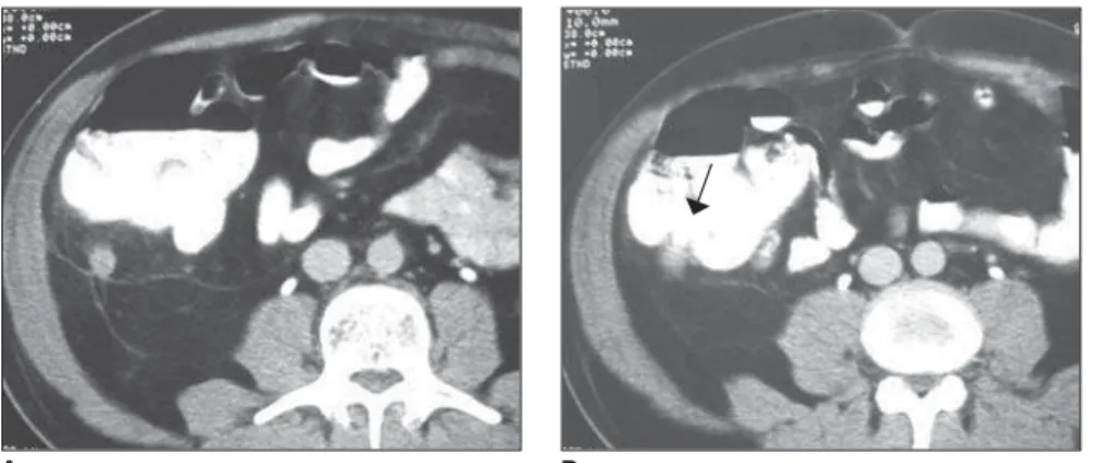 Figure 8. Computed tomography. Appendicoliths. A: Normal appendix with appendicoliths in an asymp- asymp-tomatic patient (arrow)