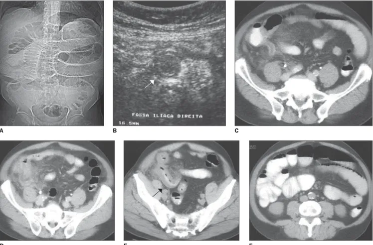 Figure 13. Male, 64-year-old patient. A: Digital radiogram B: Ultrasound (arrow). C–F: Classical findings of acute appendicitis besides signs of intestinal ob- ob-struction characterized by dilatation of small bowel loops and mural thickening of the termin